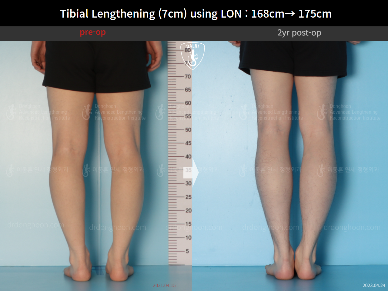 Before and after cll lon, case 14978046, image 8, Dr. Donghoon institute (DALRI)