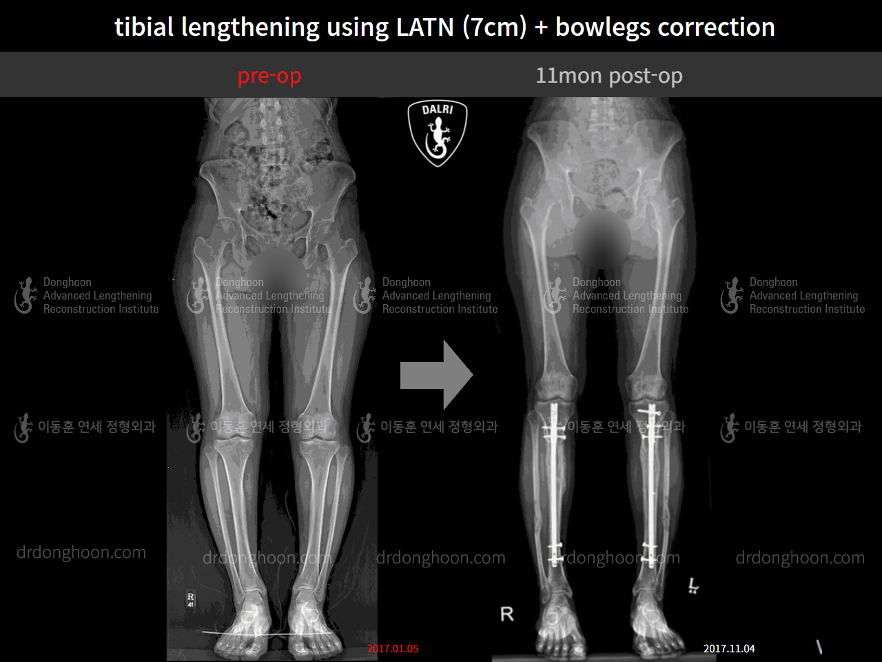 Before and after cll + deformity correction, case 9278561, image 9, Dr. Donghoon institute (DALRI)