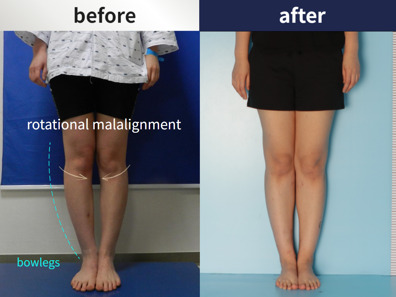 Before and after complex deformity, case 4396468, image 1, Dr. Donghoon institute (DALRI)