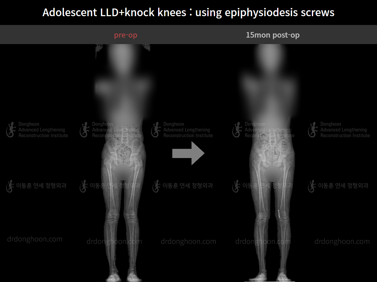 Before and after paediatric & adolescent knock knees, case 8413324, image 6, Dr. Donghoon institute (DALRI)