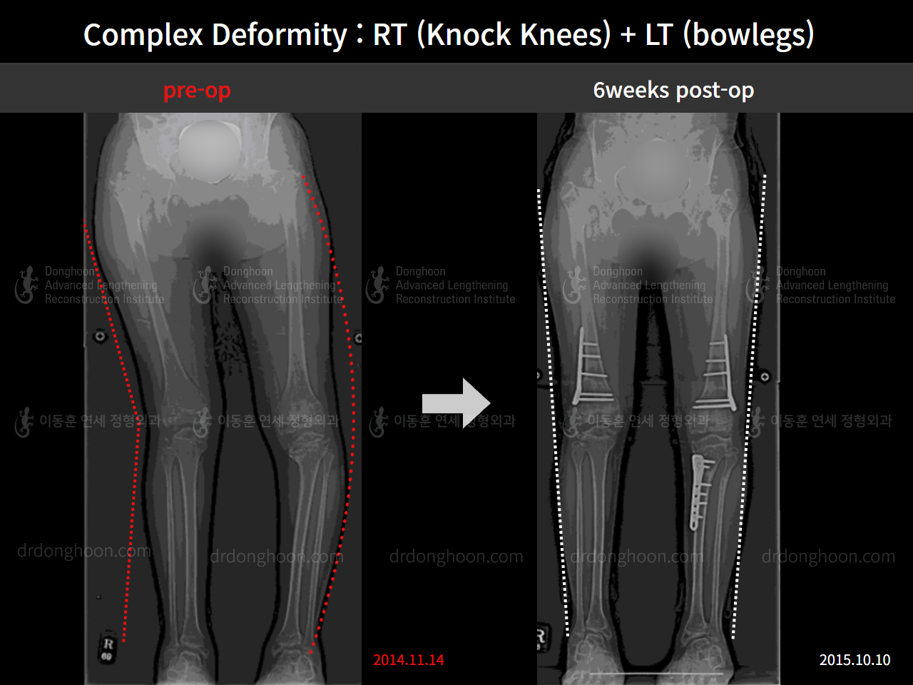 Before and after paediatric & adolescent knock knees, case 8618379, image 1, Dr. Donghoon institute (DALRI)