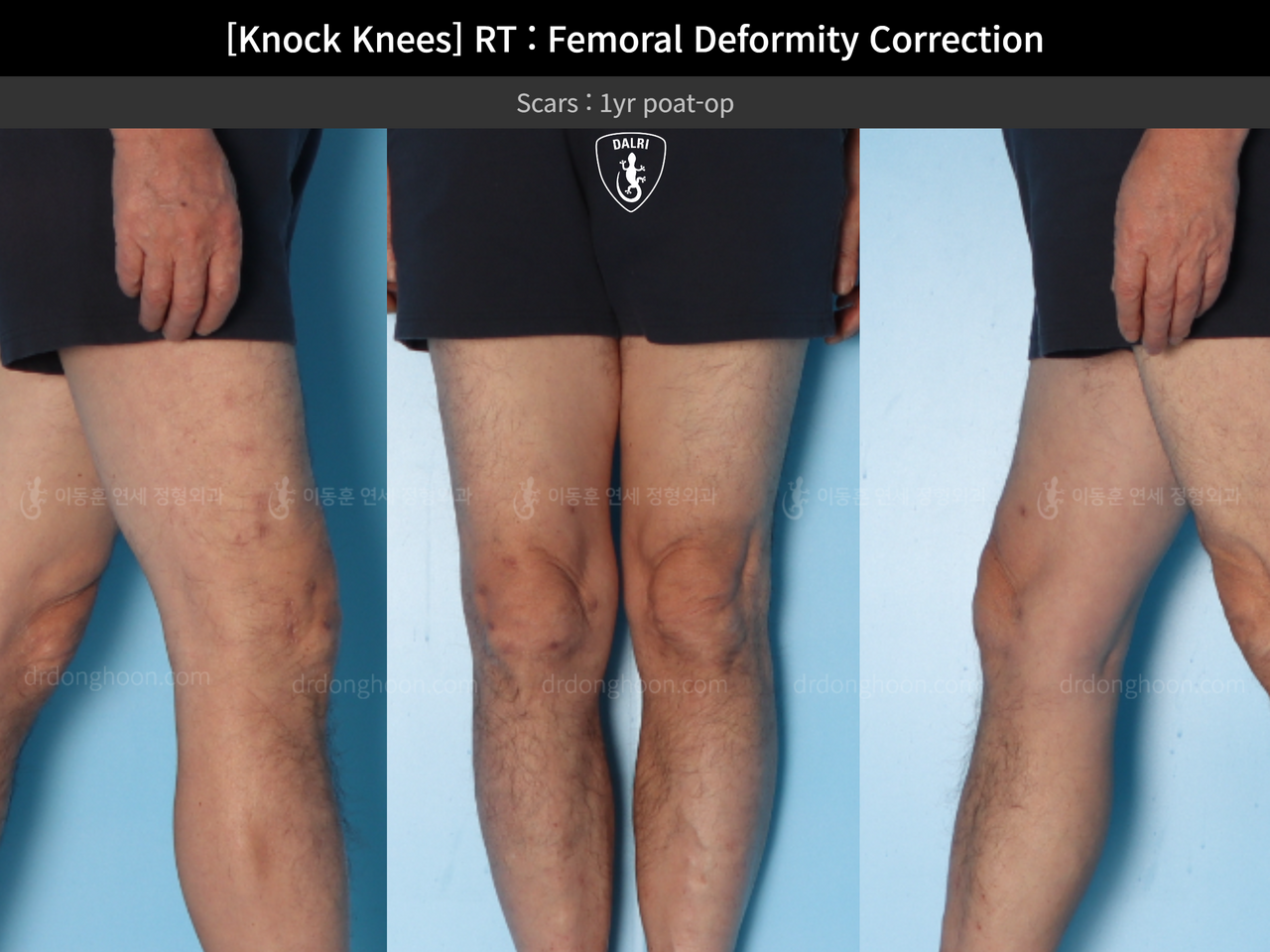 Before and after adult knock knees, case 14236357, image 9, Dr. Donghoon institute (DALRI)