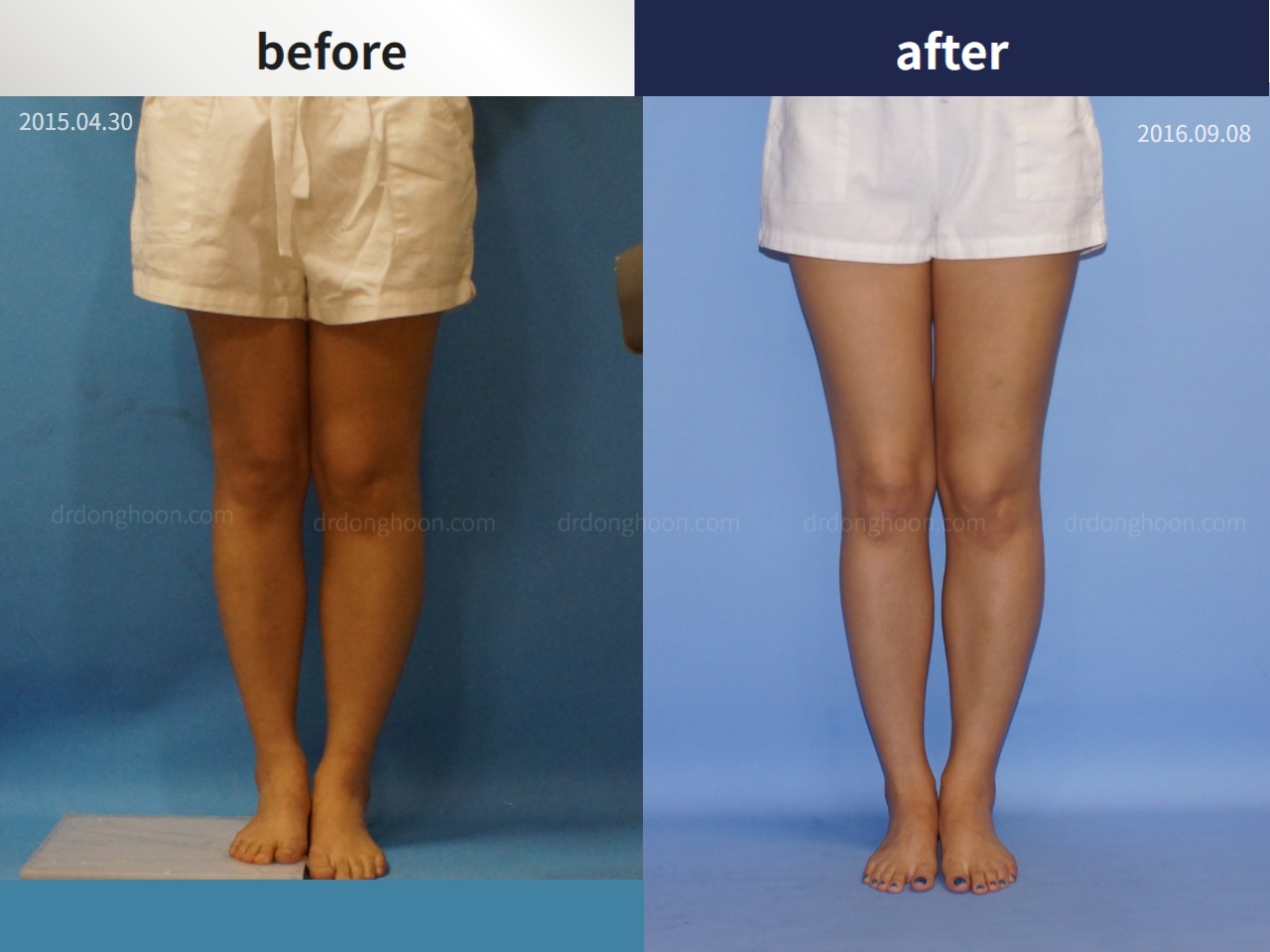 Before and after adult lld, case 4320289, image 3, Dr. Donghoon institute (DALRI)