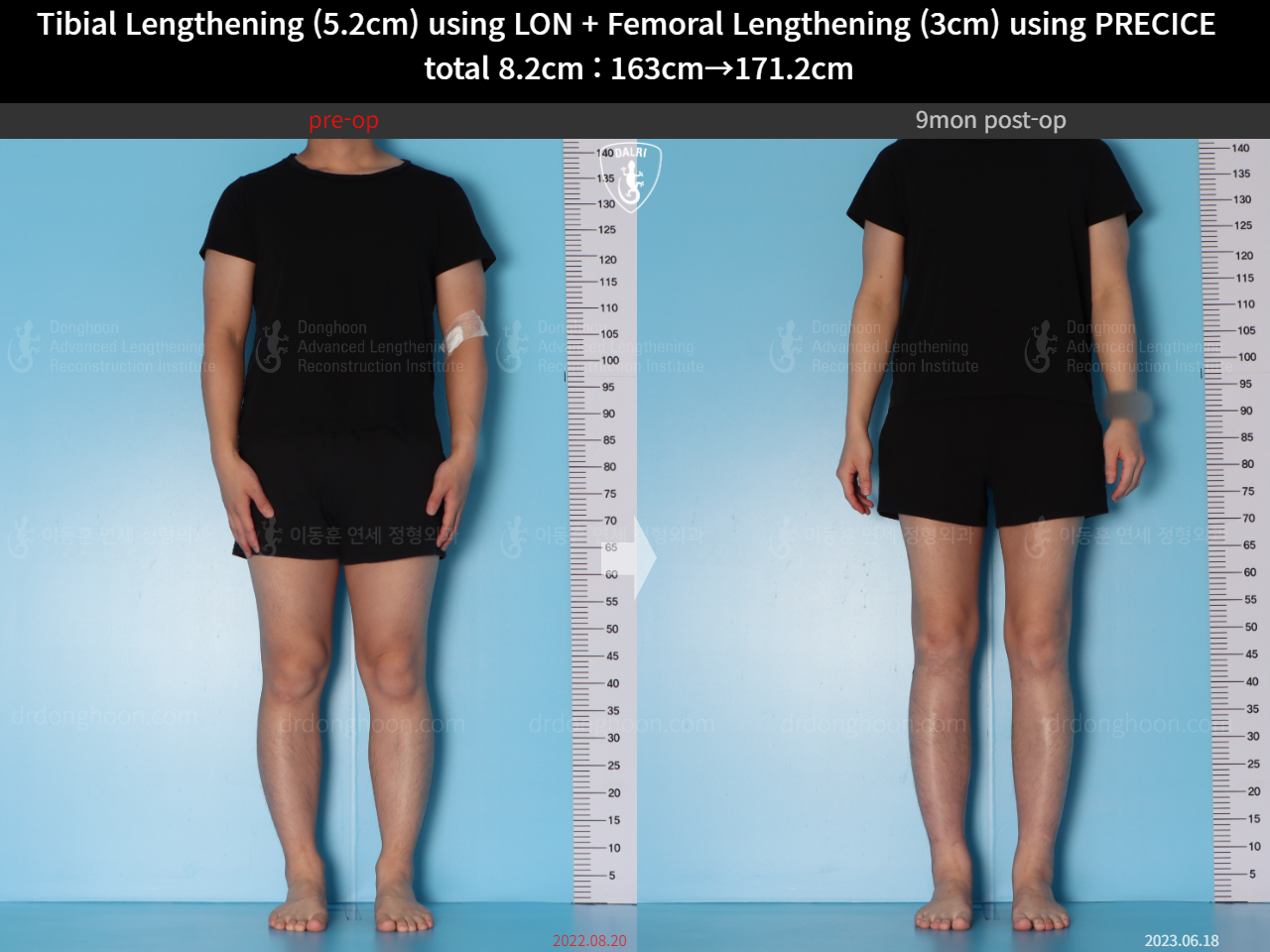 Before and after cll lon, case 15203339, image 3, Dr. Donghoon institute (DALRI)
