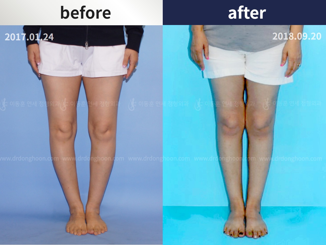 Before and after osteotomy for knee osteoarthritis, case 4306421, image 1, Dr. Donghoon institute (DALRI)