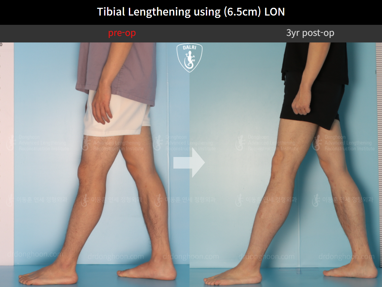 Before and after cll lon, case 9487829, image 7, Dr. Donghoon institute (DALRI)