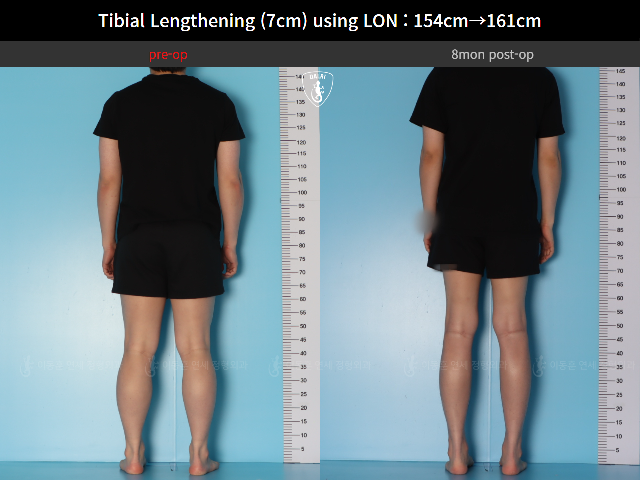 Before and after cll lon, case 127519935, image 4, Dr. Donghoon institute (DALRI)
