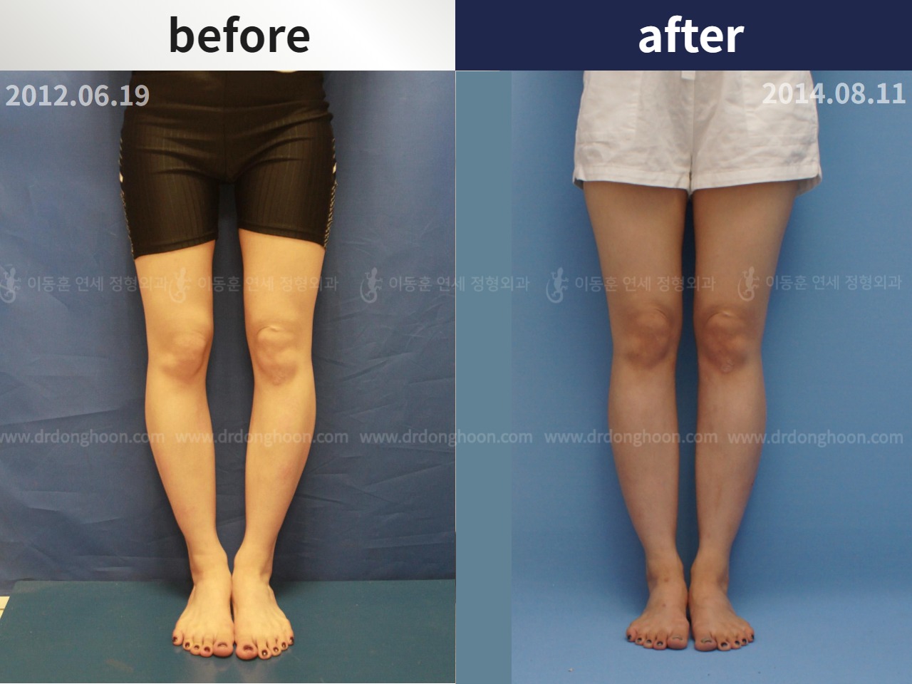 Before and after adult bowlegs, case 4310984, image 1, Dr. Donghoon institute (DALRI)
