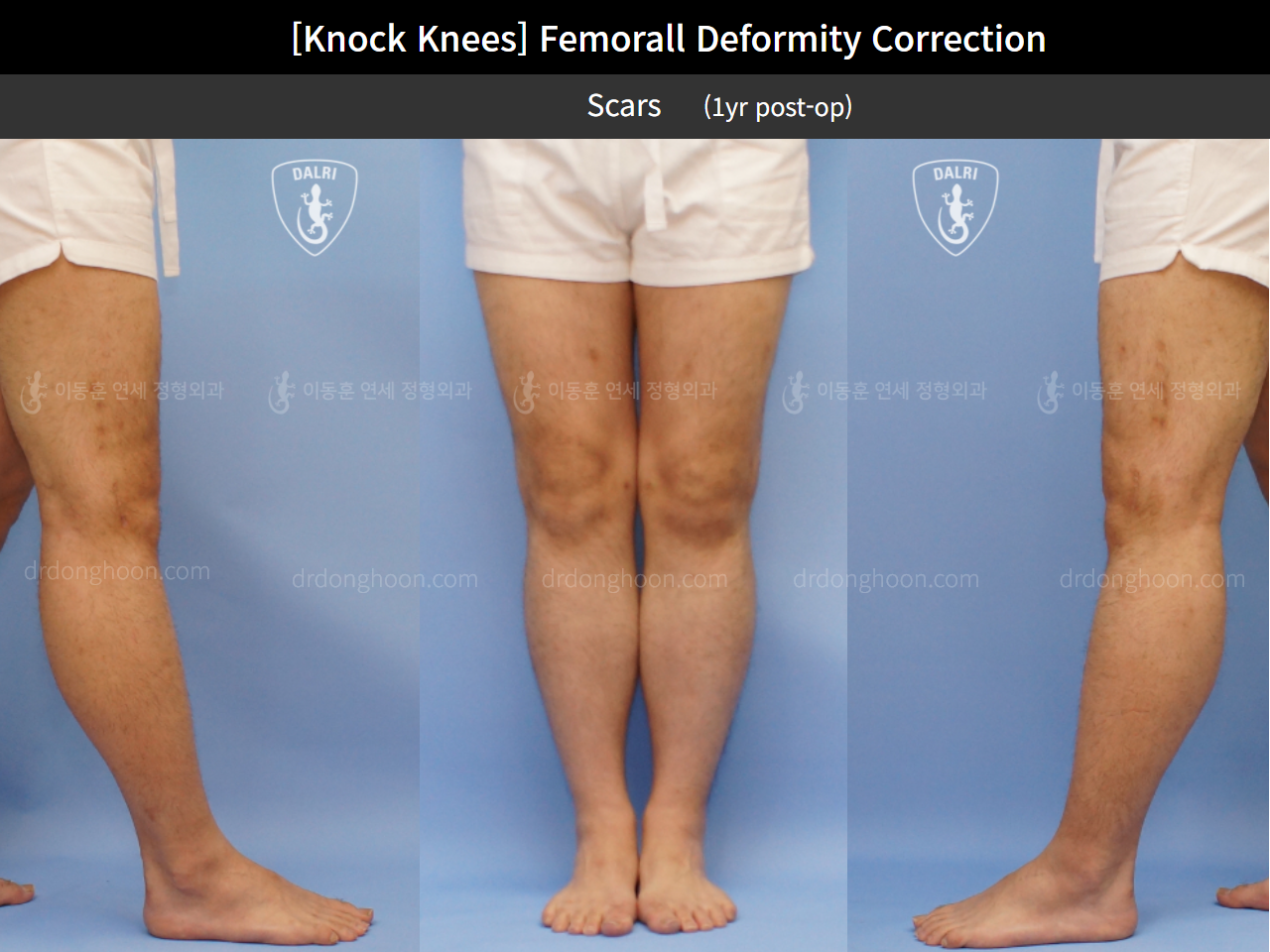 Before and after adult knock knees, case 4310847, image 5, Dr. Donghoon institute (DALRI)