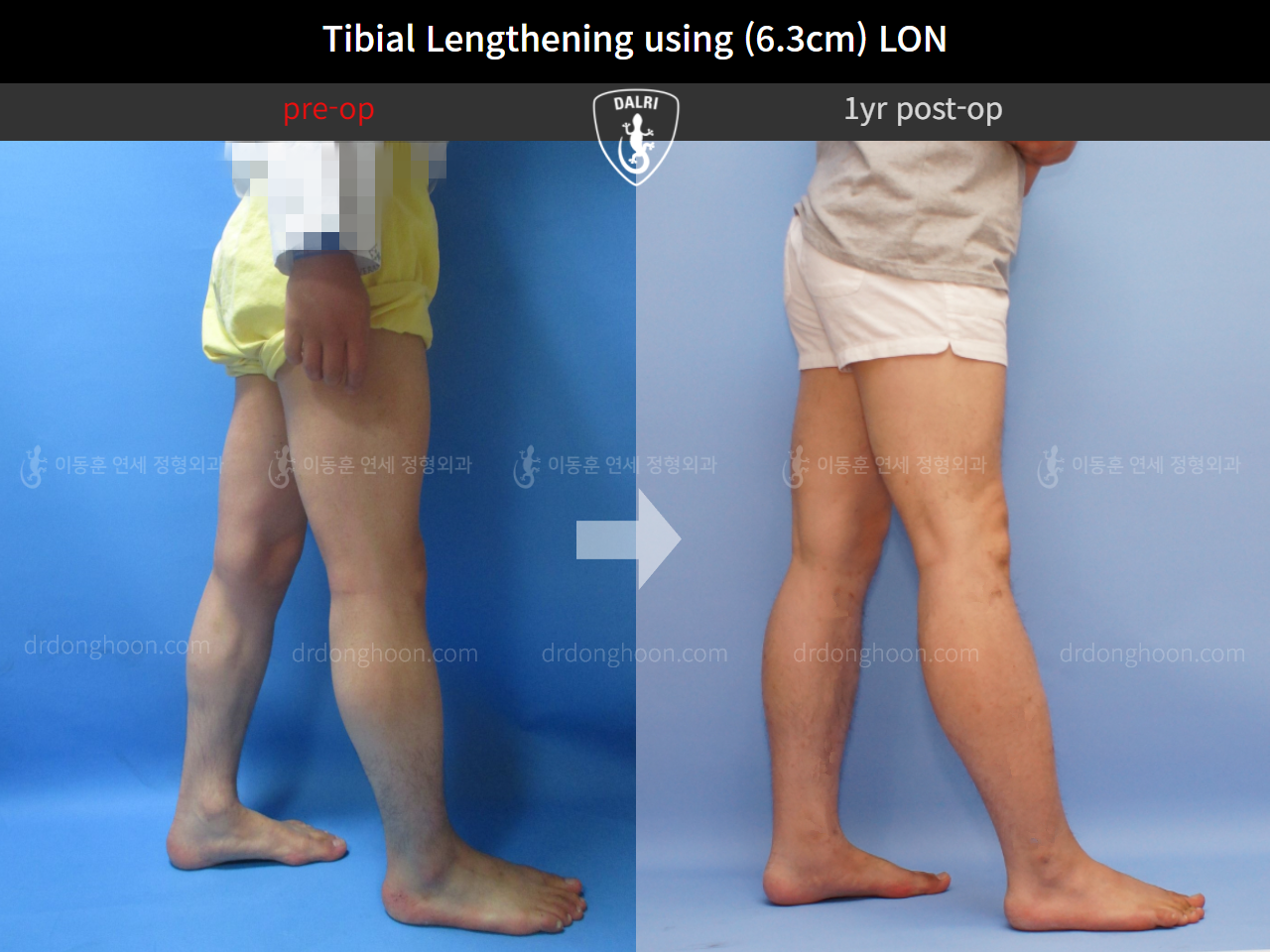 Before and after cll lon, case 4577838, image 3, Dr. Donghoon institute (DALRI)