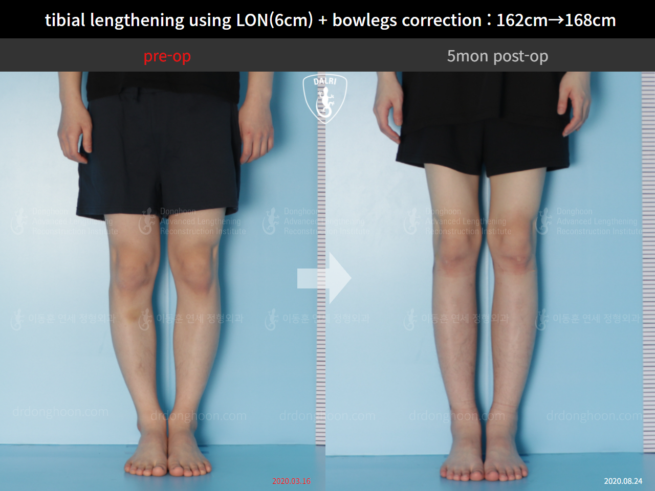 Before and after cll + deformity correction, case 5316038, image 3, Dr. Donghoon institute (DALRI)