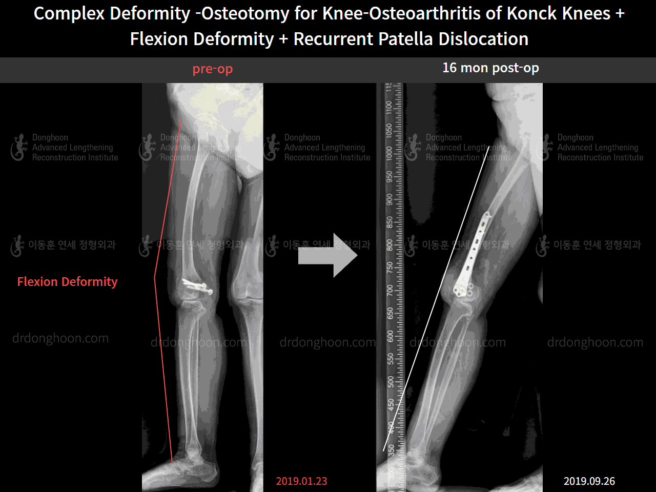 Before and after recurrent patella dislocation, case 8580605, image 4, Dr. Donghoon institute (DALRI)