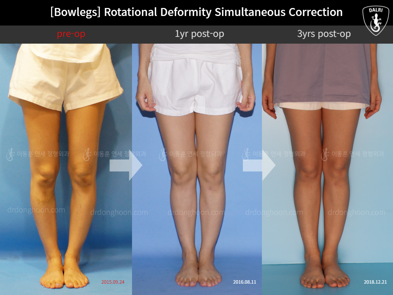 Before and after adult bowlegs, case 11789553, image 4, Dr. Donghoon institute (DALRI)