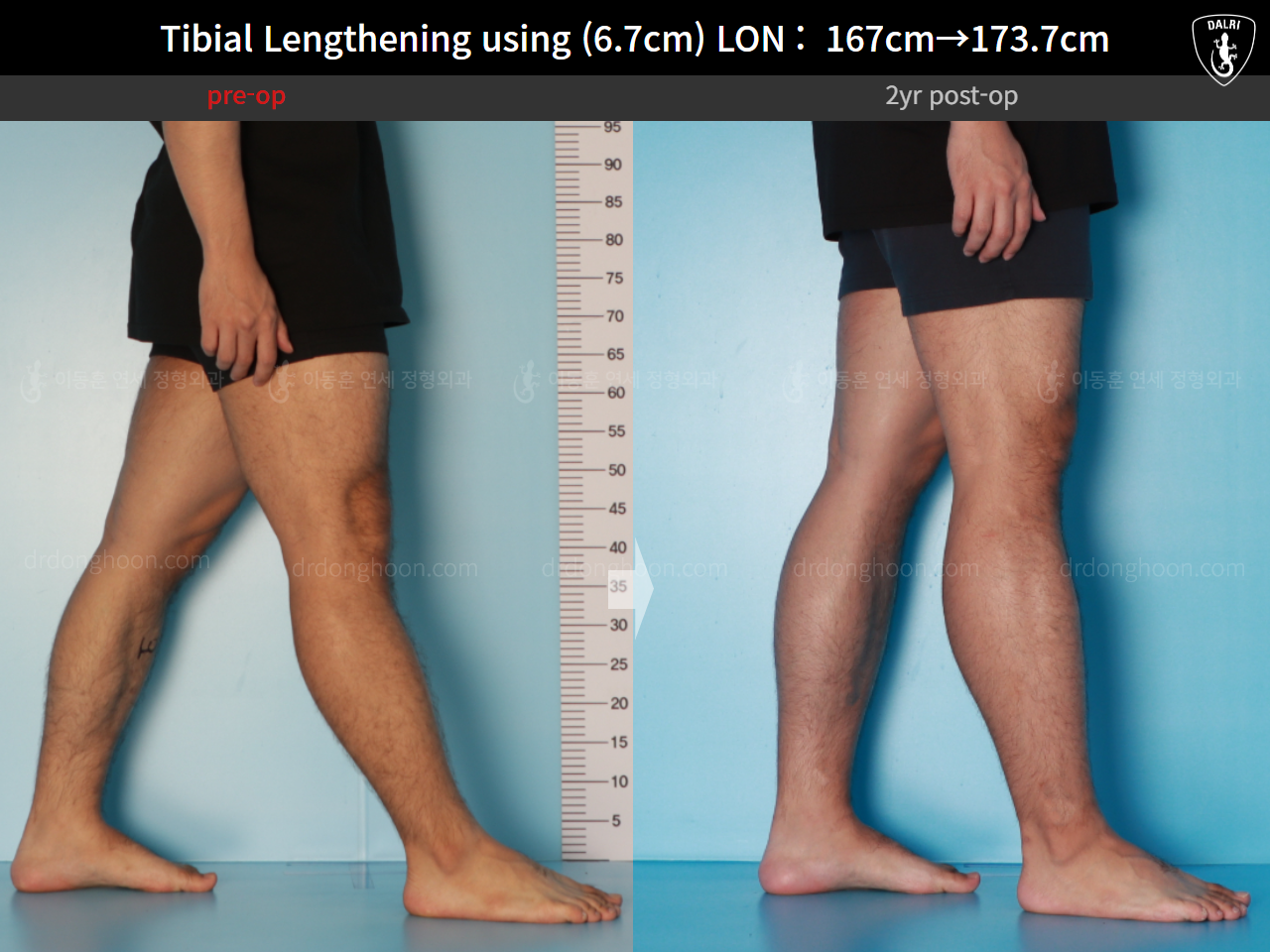 Before and after cll lon, case 16165376, image 10, Dr. Donghoon institute (DALRI)