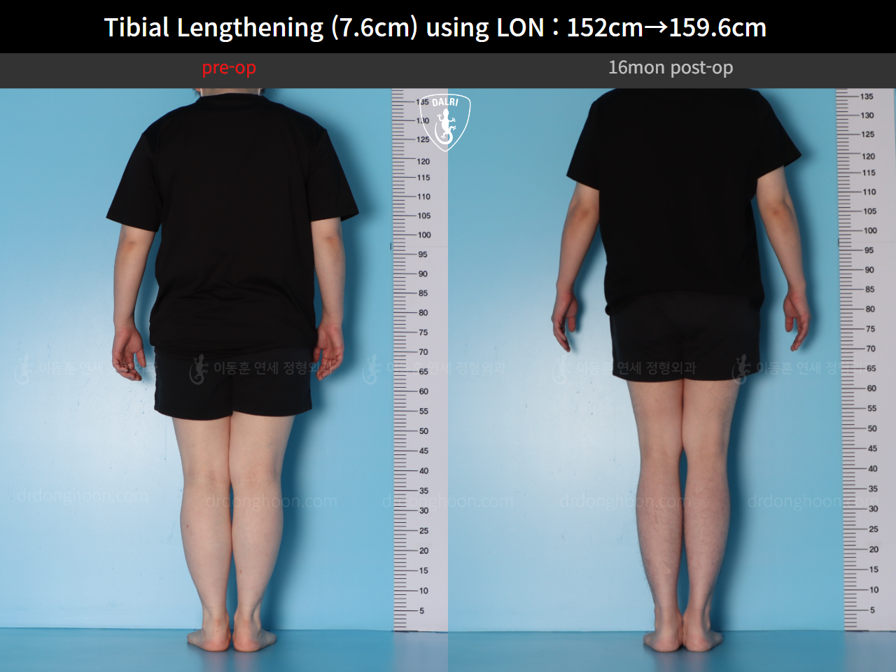 Before and after cll lon, case 123804178, image 2, Dr. Donghoon institute (DALRI)