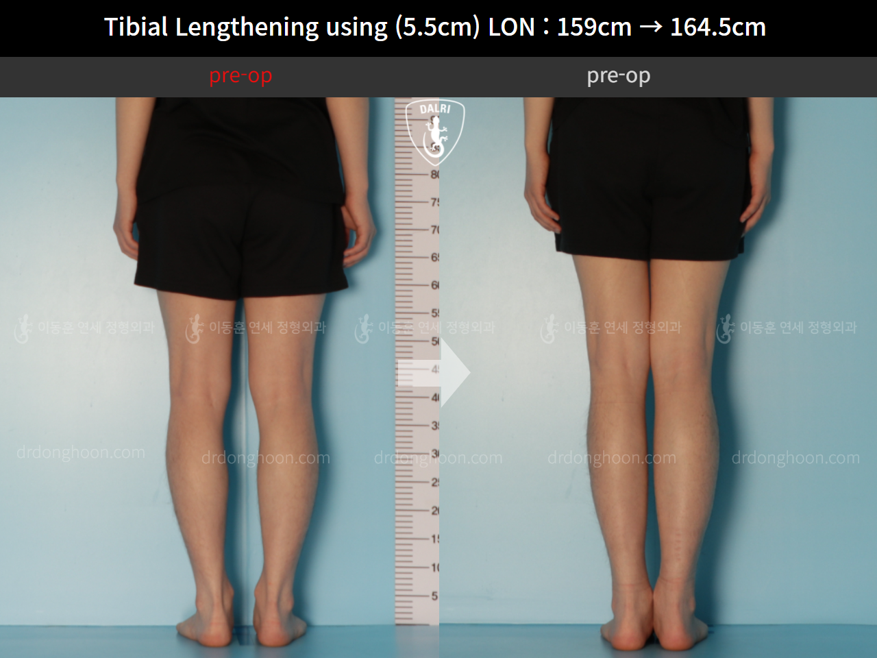 Before and after cll lon, case 11747999, image 5, Dr. Donghoon institute (DALRI)