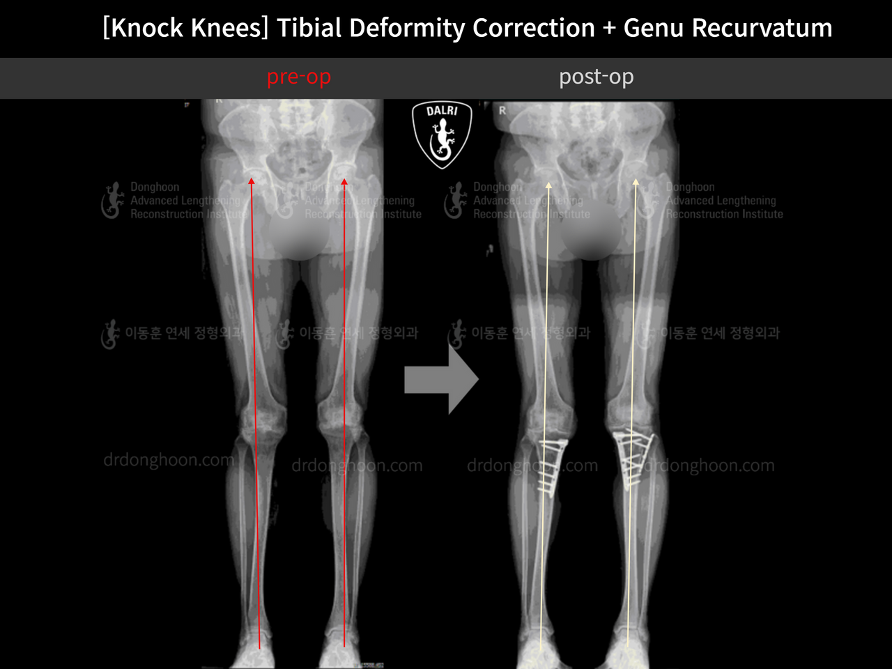 Before and after adult knock knees, case 12846255, image 10, Dr. Donghoon institute (DALRI)