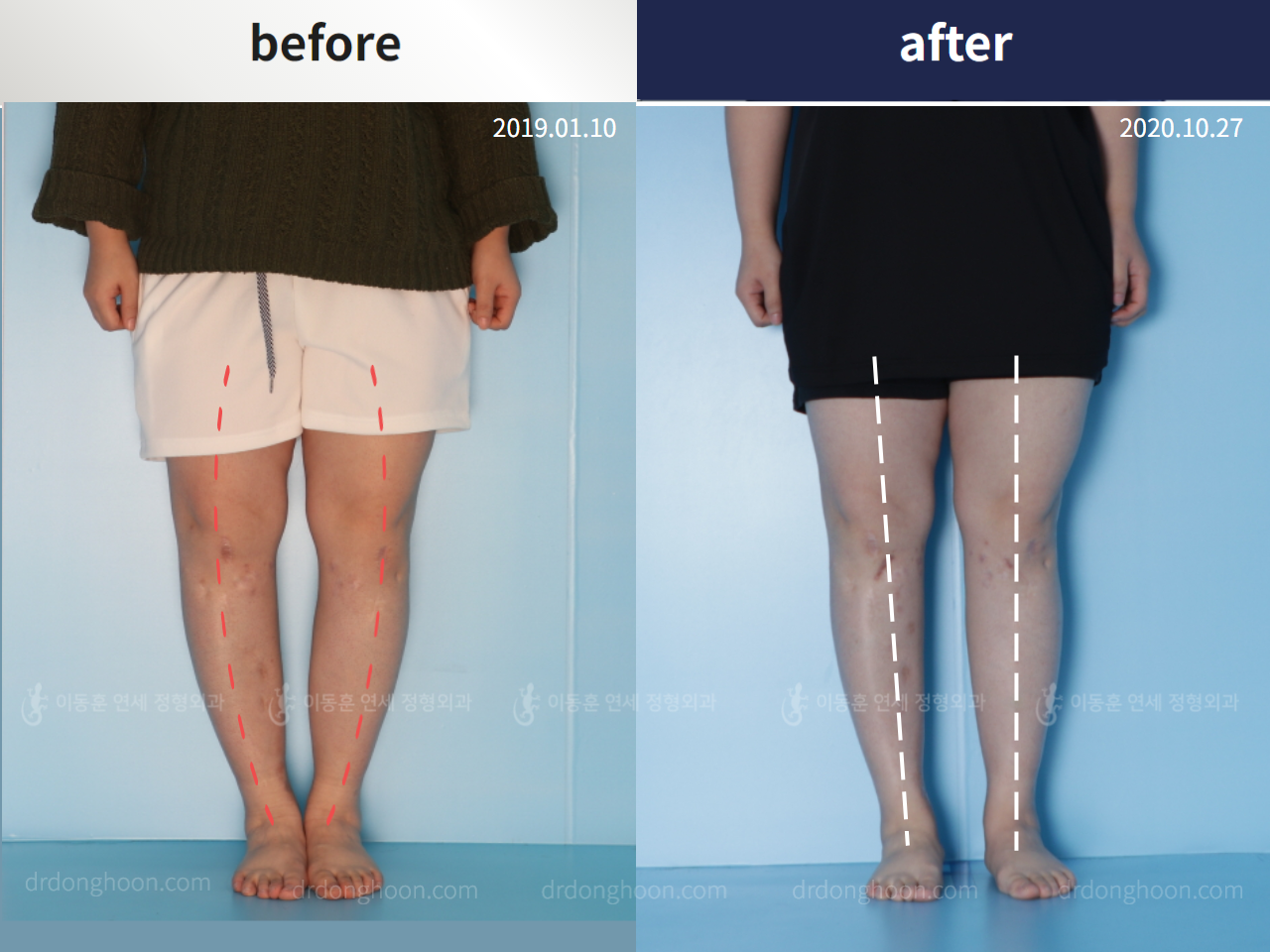 Before and after congenital condition, case 5271121, image 2, Dr. Donghoon institute (DALRI)
