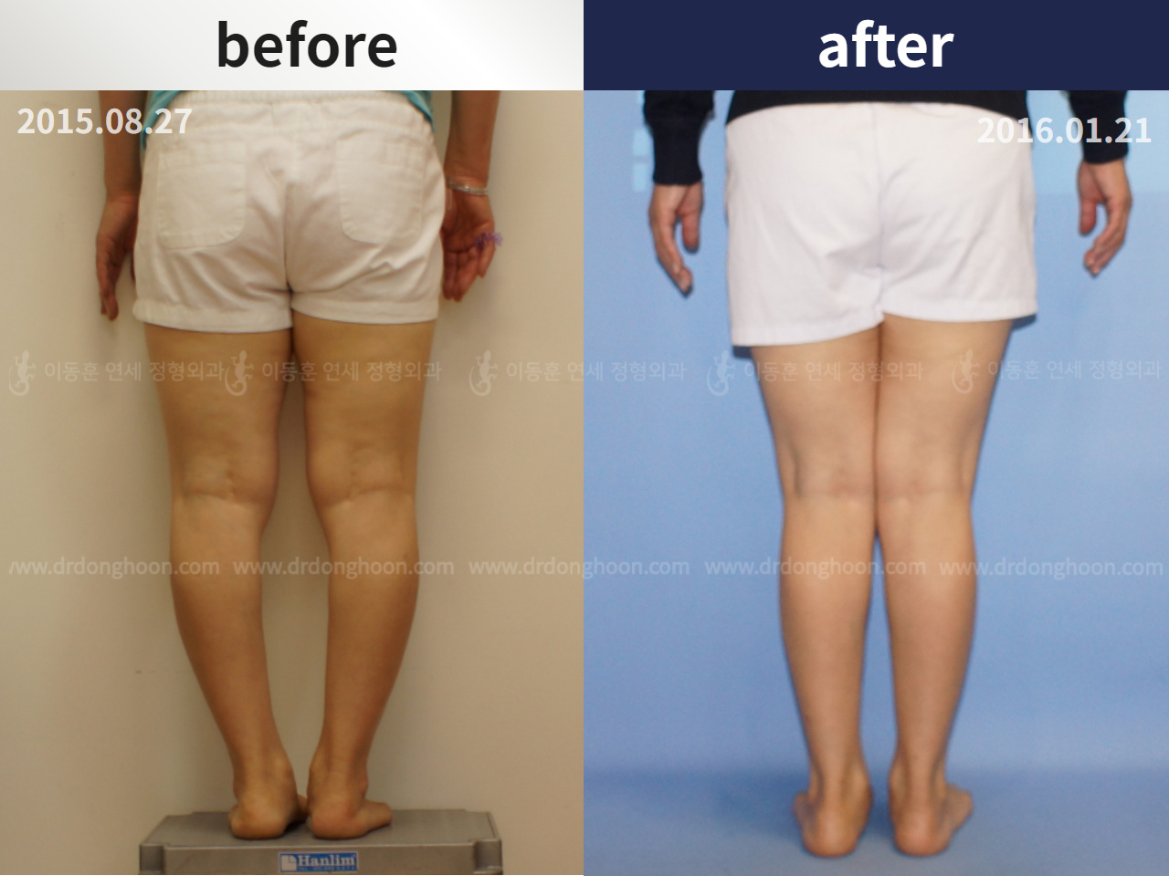 Before and after osteotomy for knee osteoarthritis, case 4306408, image 2, Dr. Donghoon institute (DALRI)