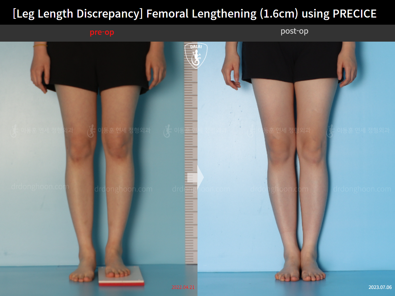 Before and after adult lld, case 15705968, image 7, Dr. Donghoon institute (DALRI)