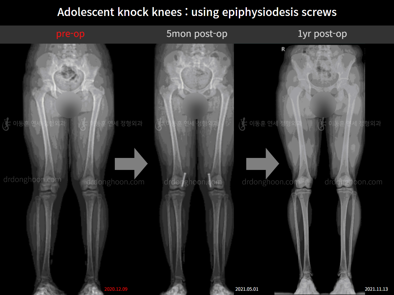 Before and after paediatric & adolescent knock knees, case 11123118, image 8, Dr. Donghoon institute (DALRI)