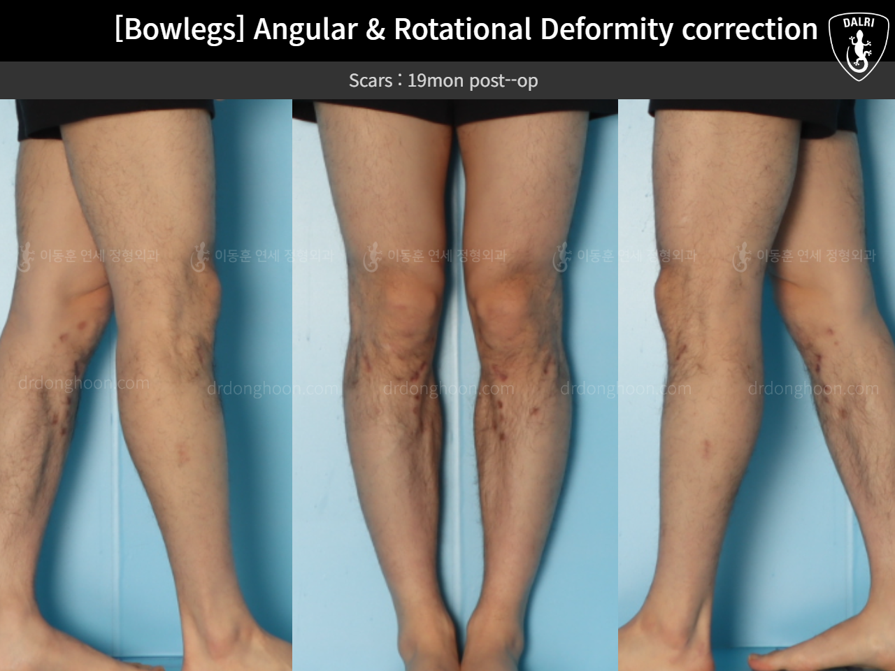 Before and after adult bowlegs, case 18306379, image 8, Dr. Donghoon institute (DALRI)