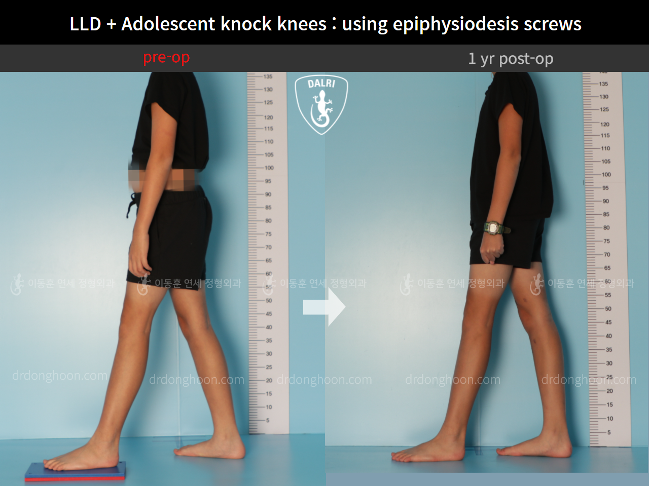 Before and after paediatric & adolescent knock knees, case 9186061, image 7, Dr. Donghoon institute (DALRI)