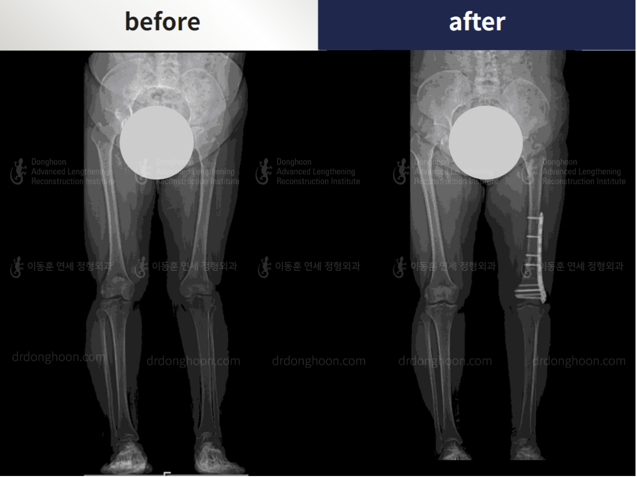 Before and after complex deformity, case 4251607, image 3, Dr. Donghoon institute (DALRI)