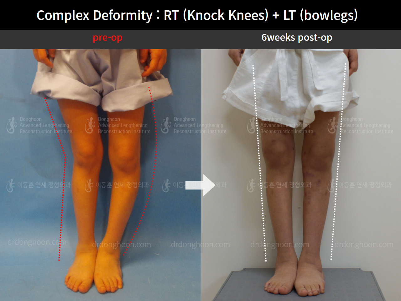 Before and after paediatric & adolescent knock knees, case 8618379, image 3, Dr. Donghoon institute (DALRI)