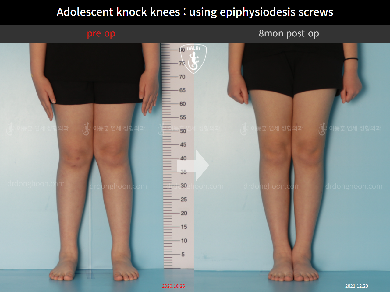 Before and after paediatric & adolescent knock knees, case 10297056, image 3, Dr. Donghoon institute (DALRI)