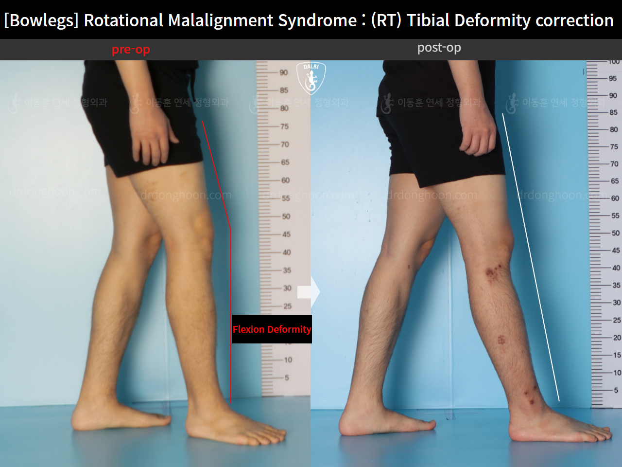 Before and after adult bowlegs, case 16482195, image 6, Dr. Donghoon institute (DALRI)