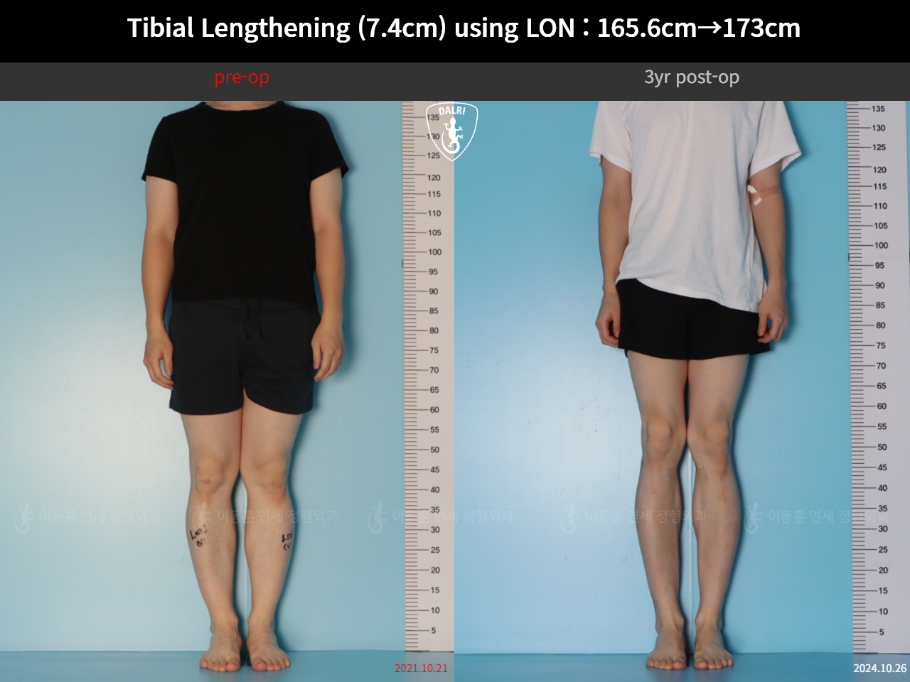 Before and after cll lon, case 125561518, image 3, Dr. Donghoon institute (DALRI)