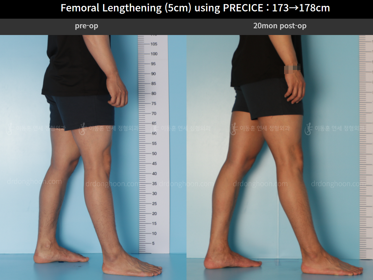 Before and after cll precice, case 4573533, image 7, Dr. Donghoon institute (DALRI)