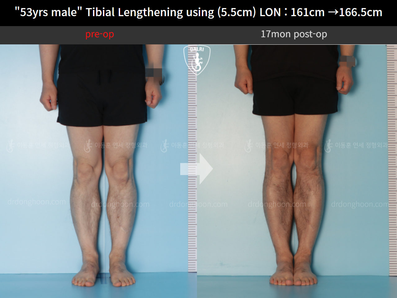 "53yrs Male" Tibial Lengthening Using (5.5cm) LON : 161cm →166.5cm ...