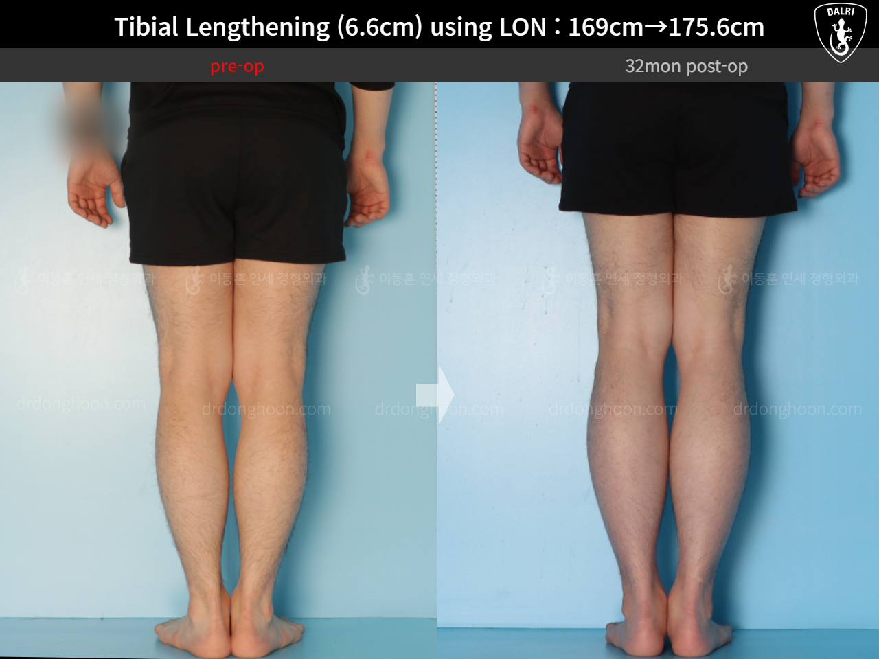 Before and after cll lon, case 15166302, image 10, Dr. Donghoon institute (DALRI)