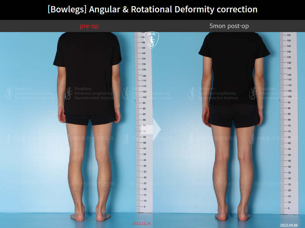Before and after adult bowlegs, case 14707617, image 4, Dr. Donghoon institute (DALRI)