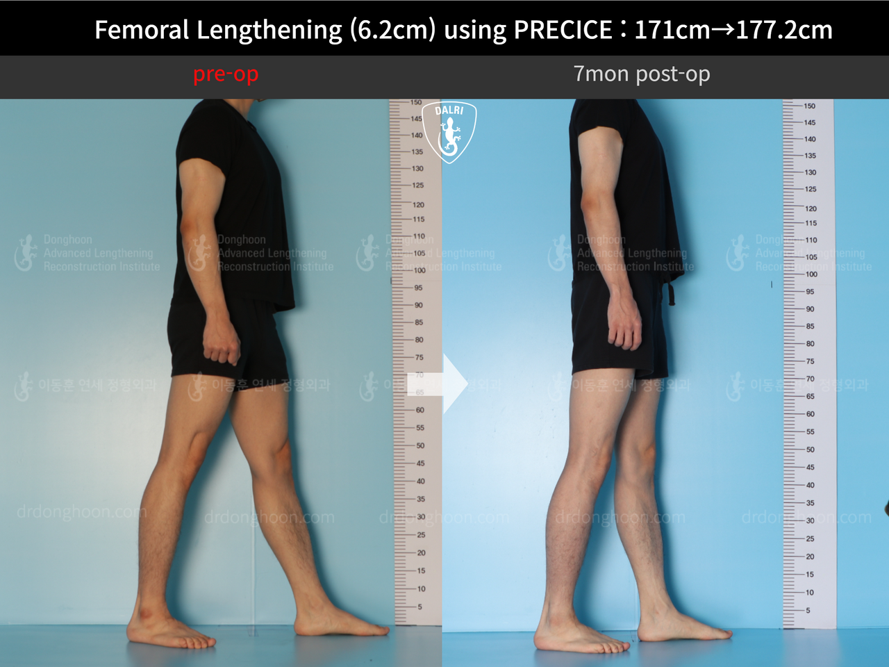 Before and after cll precice, case 13325833, image 6, Dr. Donghoon institute (DALRI)