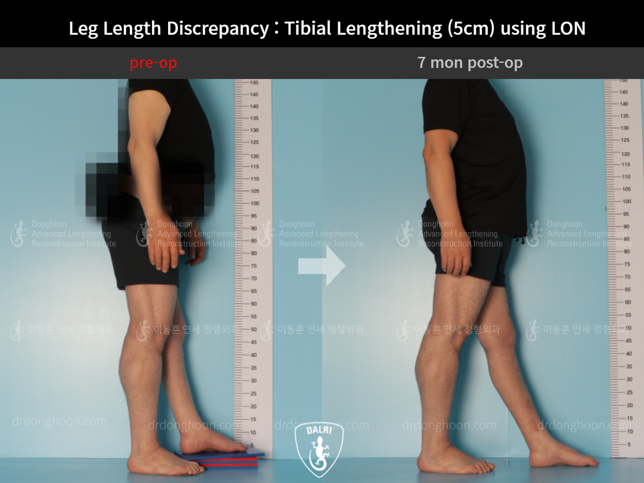 Before and after adult lld, case 9165807, image 4, Dr. Donghoon institute (DALRI)