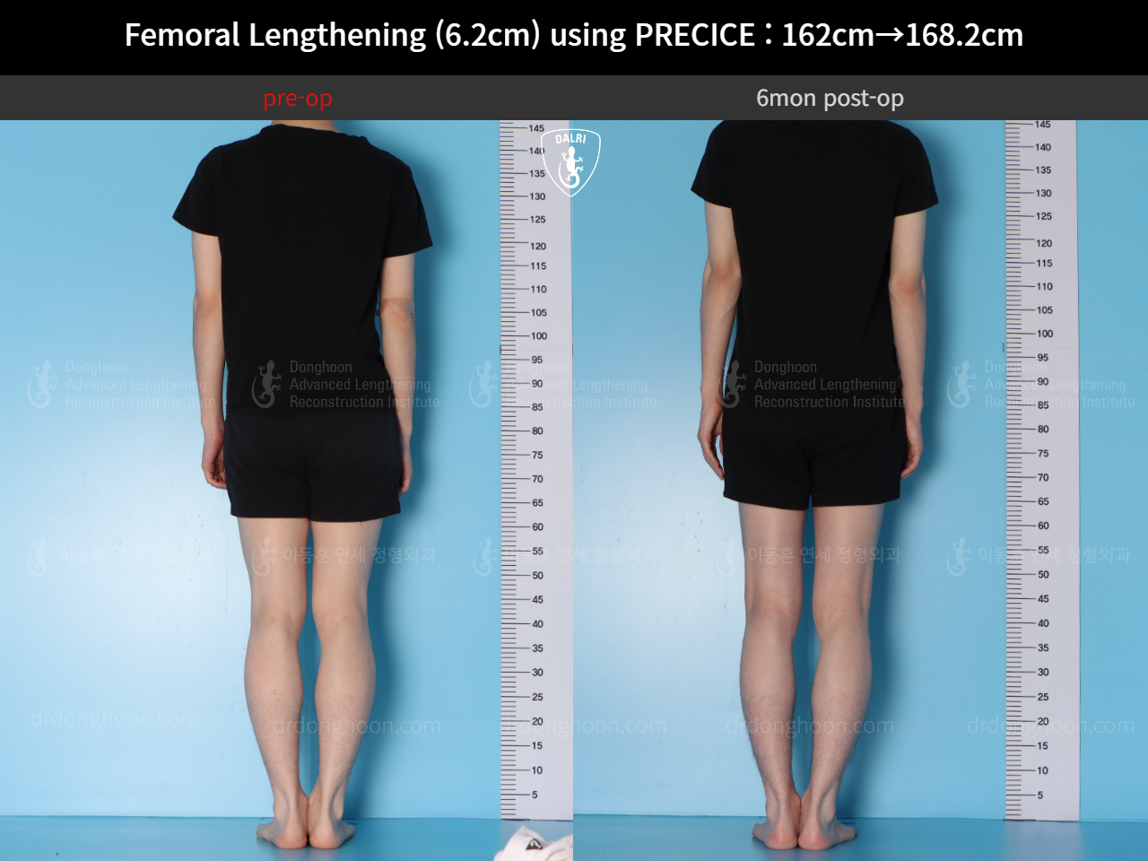 Before and after cll precice, case 15393865, image 3, Dr. Donghoon institute (DALRI)
