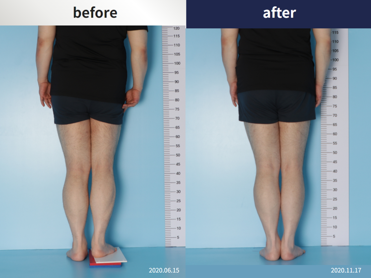 Before and after complex deformity, case 5346191, image 3, Dr. Donghoon institute (DALRI)