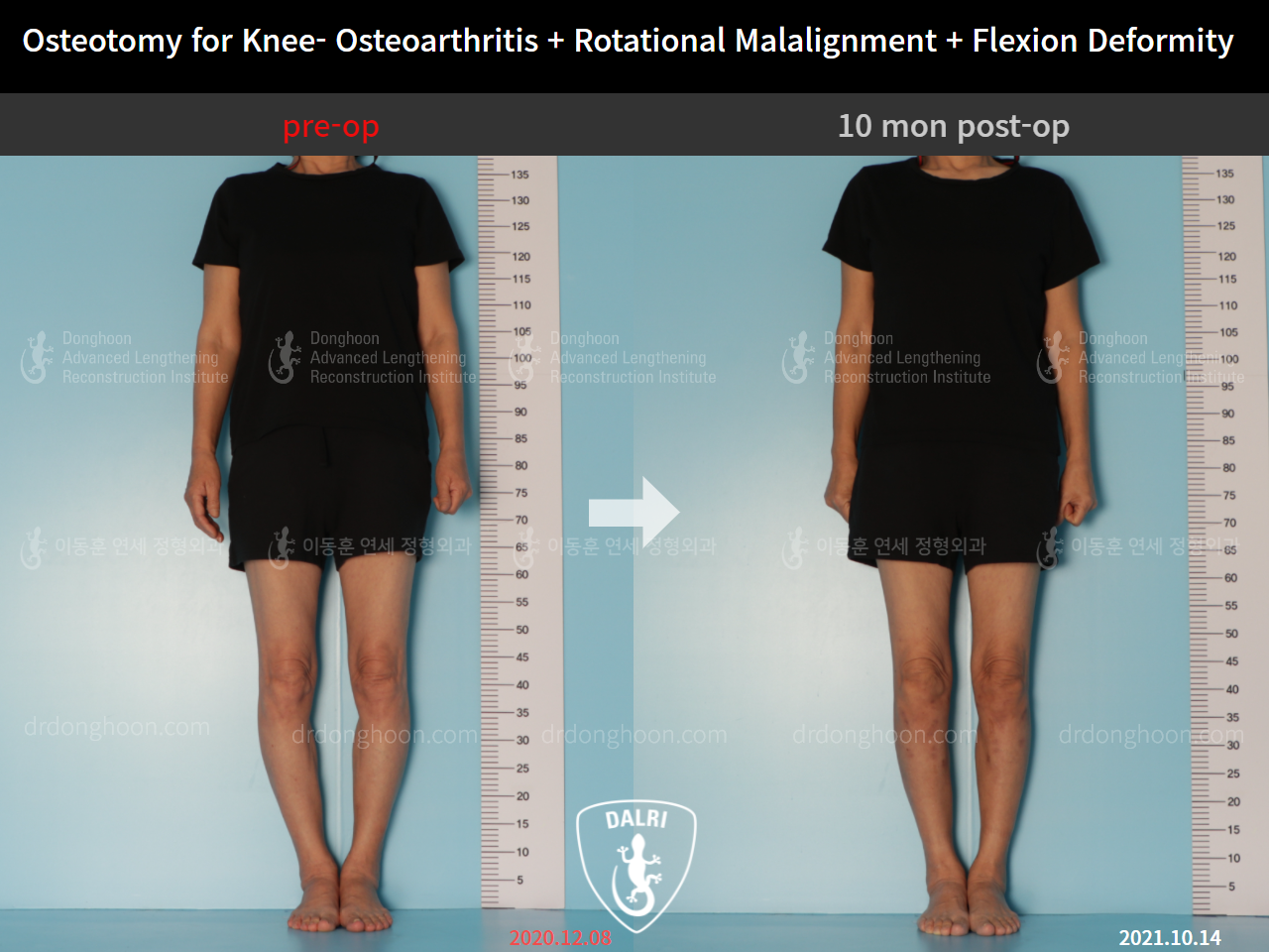 Before and after adult bowlegs, case 9128510, image 1, Dr. Donghoon institute (DALRI)
