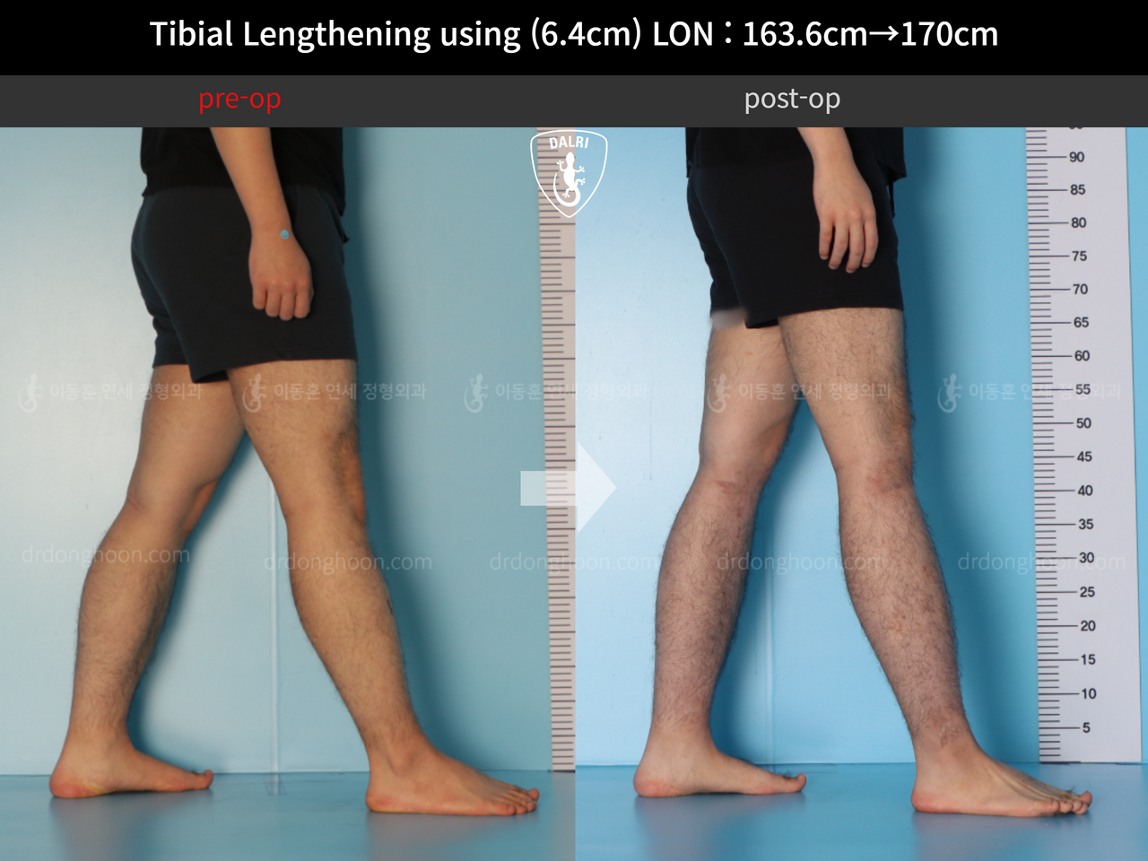 Before and after cll lon, case 12779092, image 7, Dr. Donghoon institute (DALRI)
