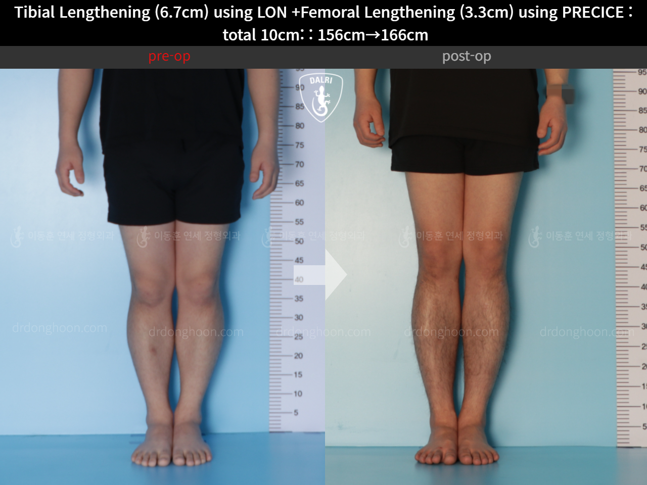 Before and after cll lon, case 11044268, image 5, Dr. Donghoon institute (DALRI)