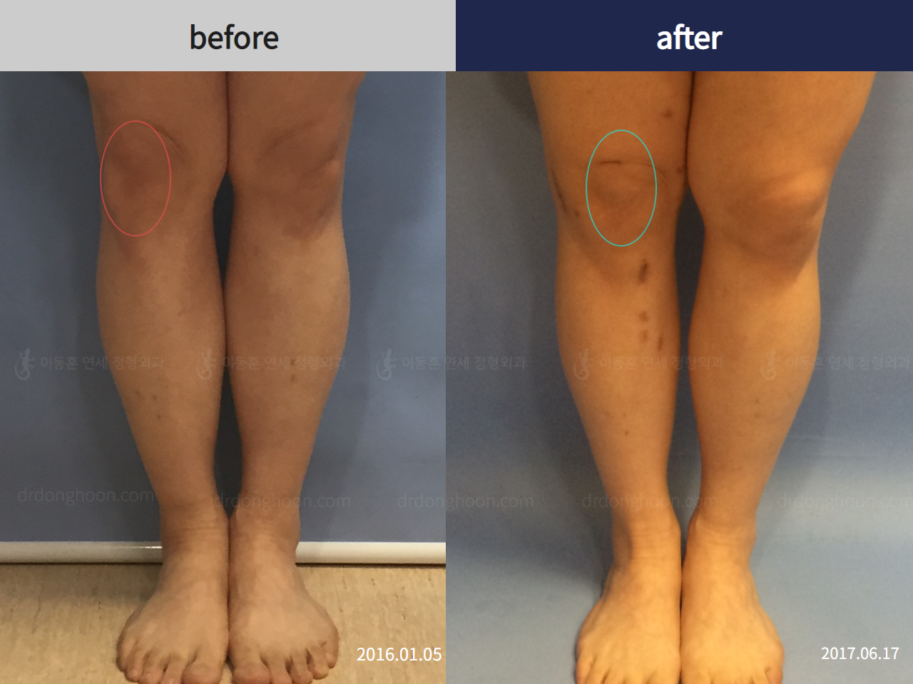 Before and after reoperation after deformity correction, case 4306365, image 3, Dr. Donghoon institute (DALRI)