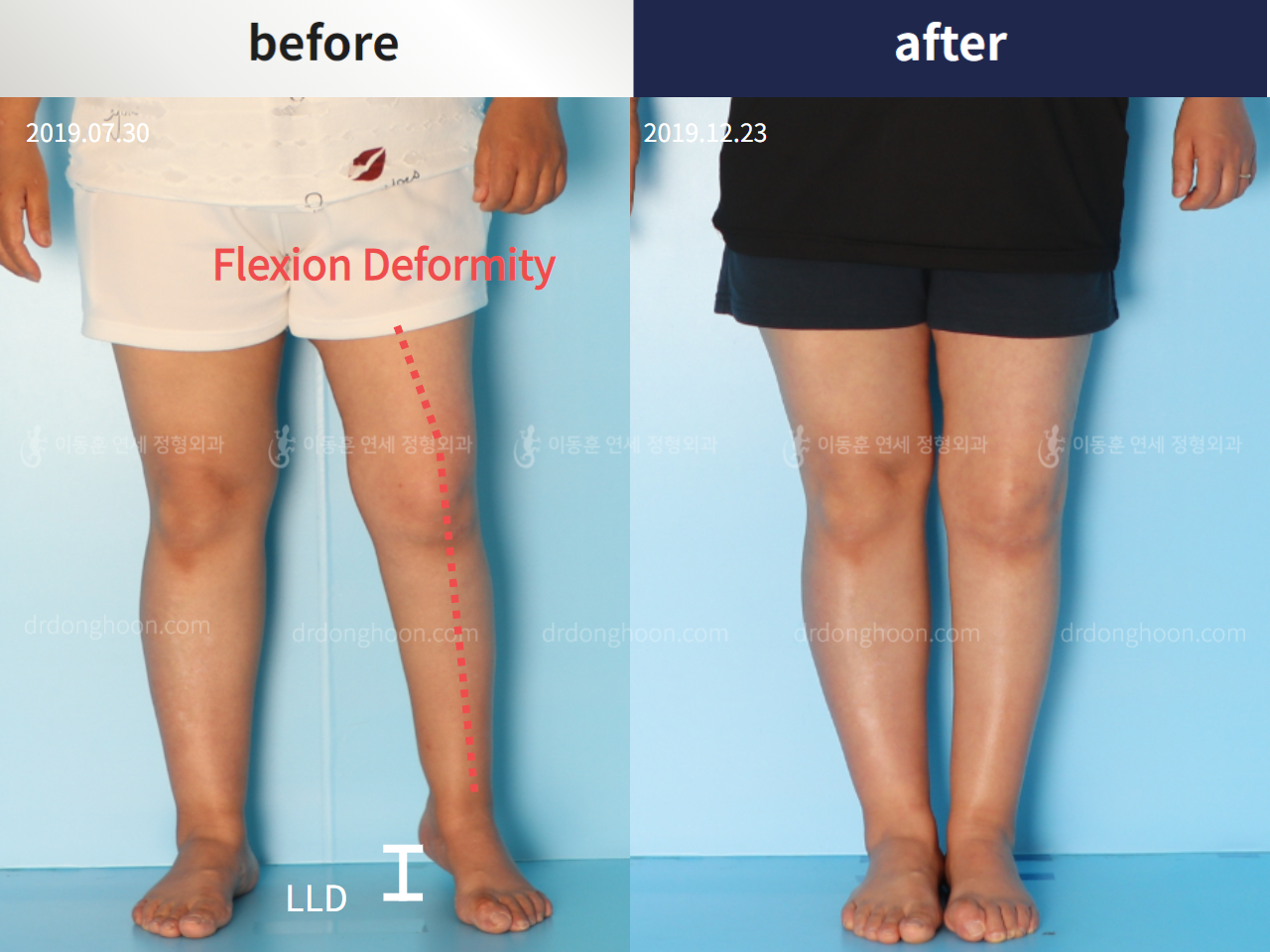 Before and after complex deformity, case 4251607, image 1, Dr. Donghoon institute (DALRI)
