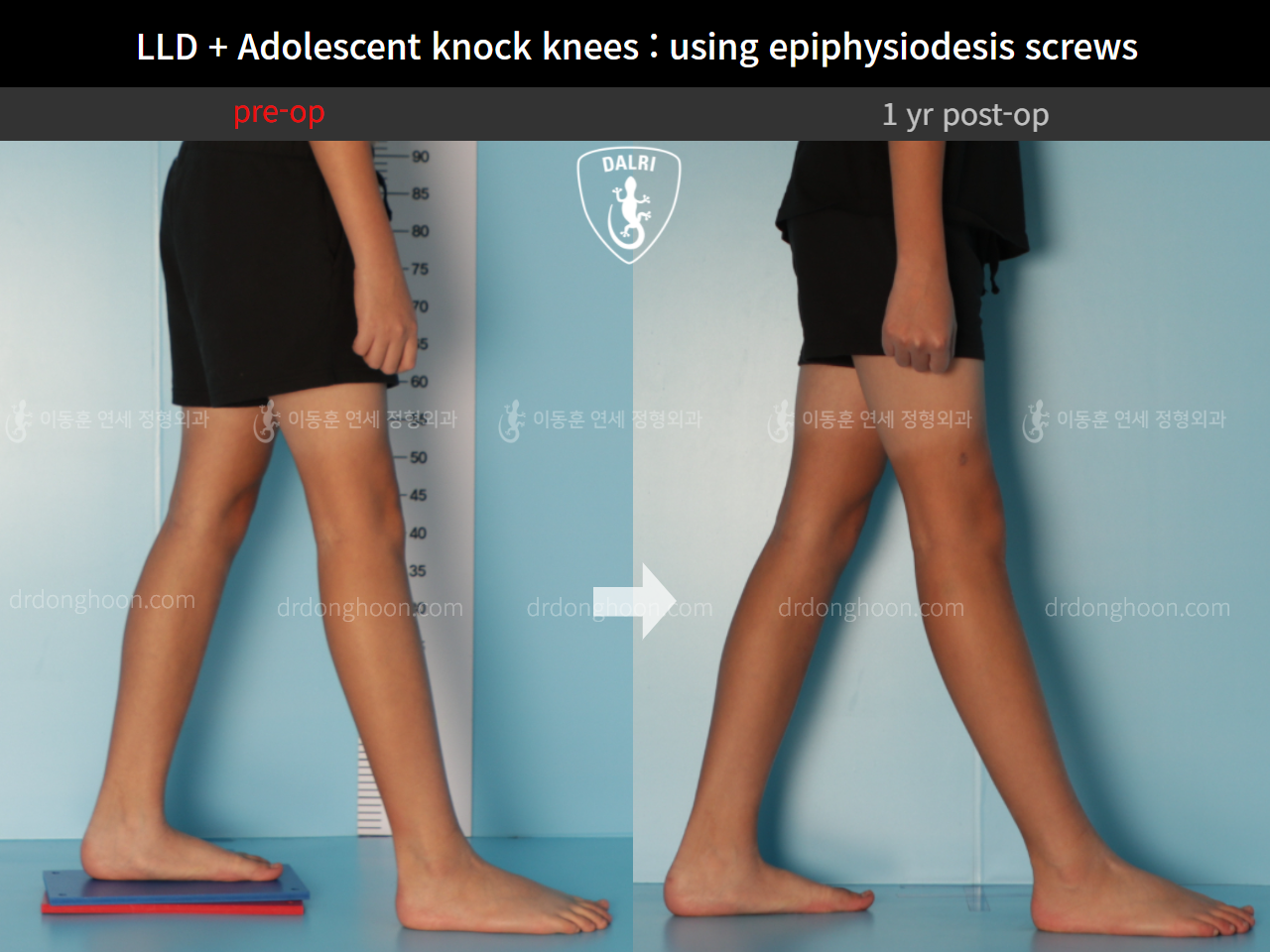 Before and after paediatric & adolescent knock knees, case 9186061, image 4, Dr. Donghoon institute (DALRI)
