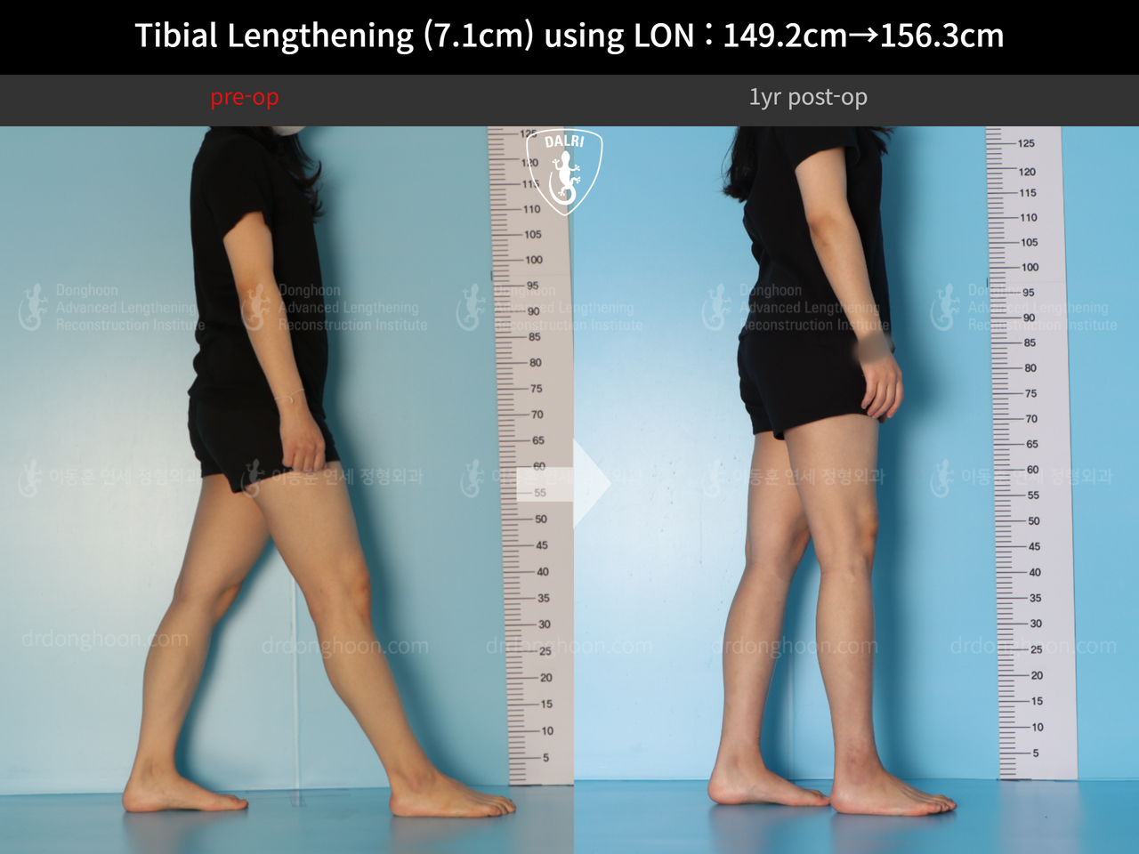 Before and after cll lon, case 14264800, image 3, Dr. Donghoon institute (DALRI)