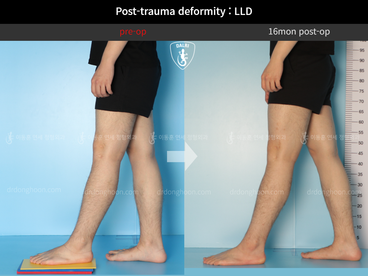 Before and after adult lld, case 11086886, image 6, Dr. Donghoon institute (DALRI)