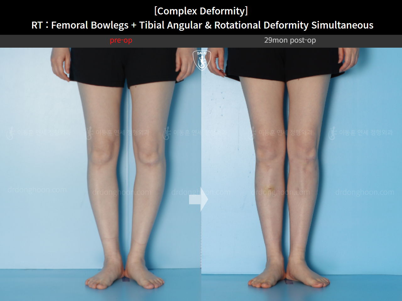 Before and after adult bowlegs, case 14771490, image 7, Dr. Donghoon institute (DALRI)