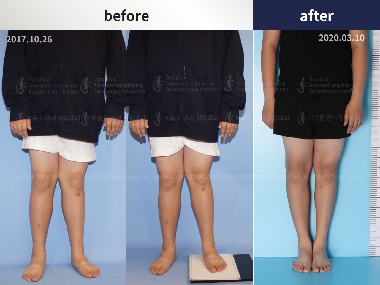 Before and after paediatric & adolescent knock knees, case 4310935, image 2, Dr. Donghoon institute (DALRI)